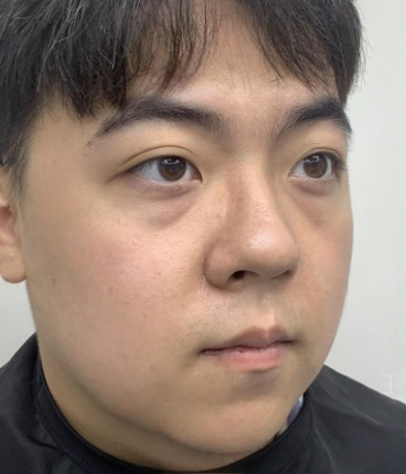去眼袋手术