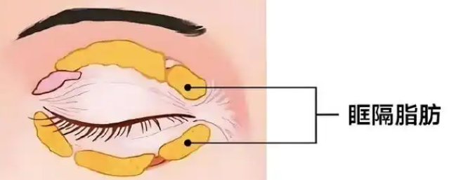 去眼袋手术