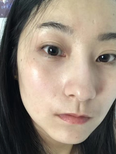 去眼袋手术