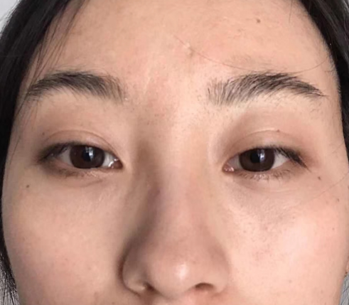 去眼袋手术