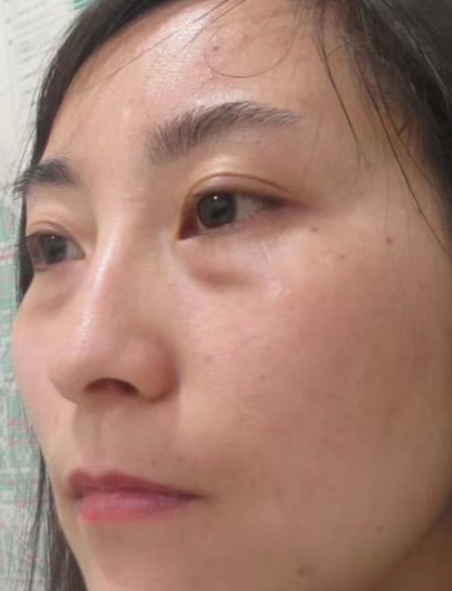 去眼袋手术
