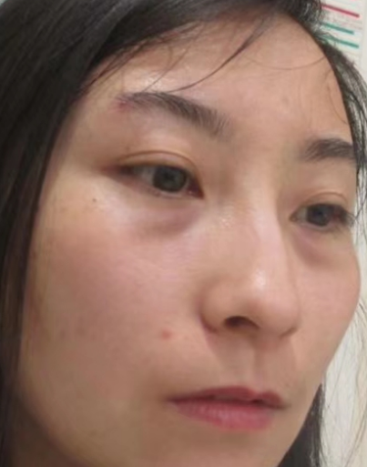 去眼袋手术