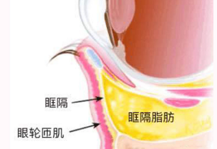 去眼袋手术