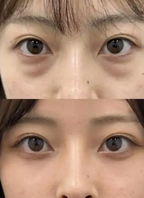 去眼袋手术