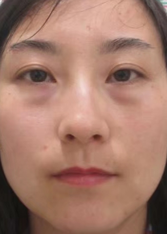 去眼袋手术