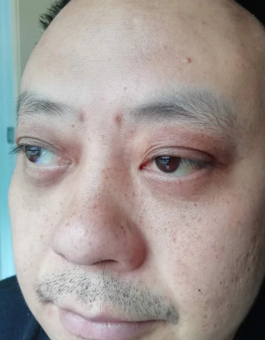 去眼袋手术