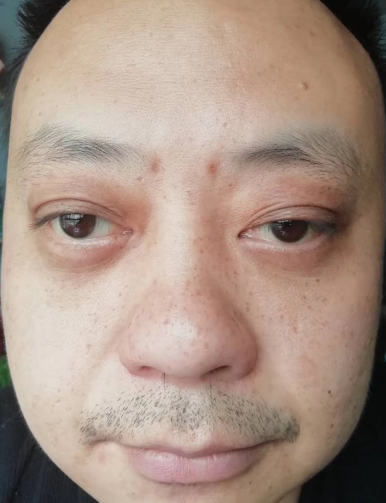 去眼袋手术
