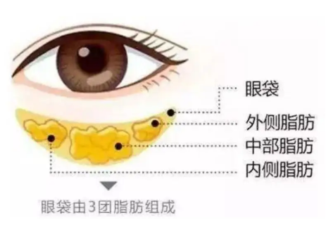 去眼袋手术