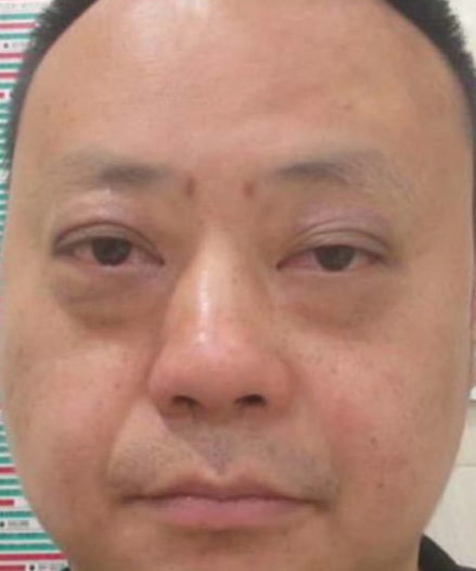 去眼袋手术
