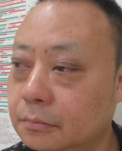 去眼袋手术