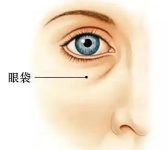 去眼袋手术
