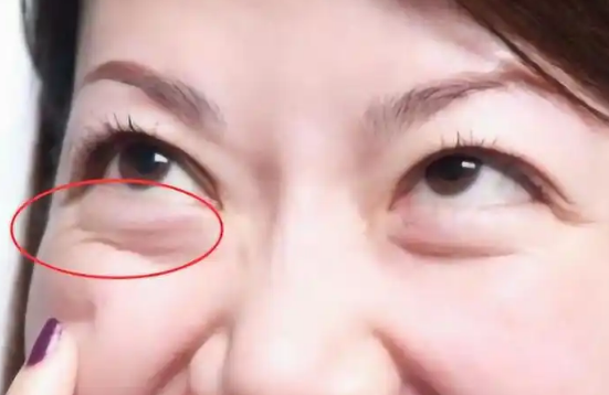 眼袋