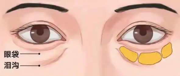 眼袋