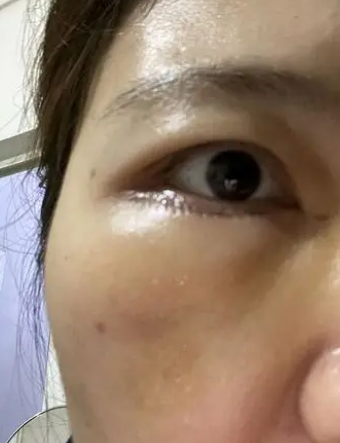 眼袋