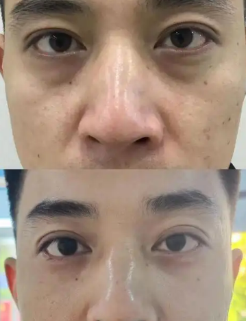 眼袋