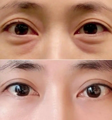 眼袋