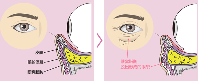 眼袋