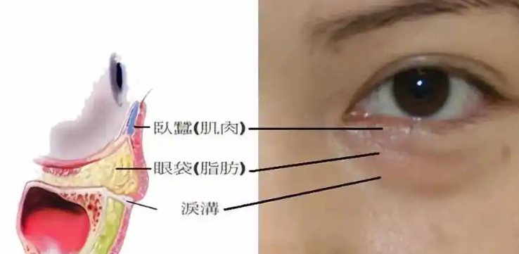 去眼袋手术