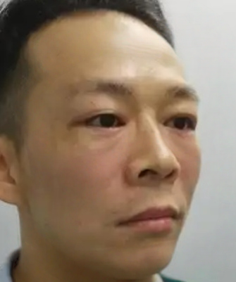 去眼袋手术