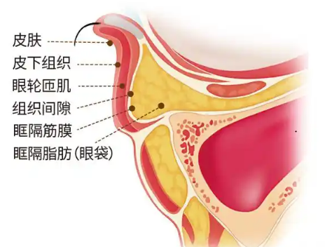 去眼袋手术