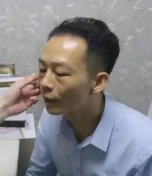 去眼袋手术