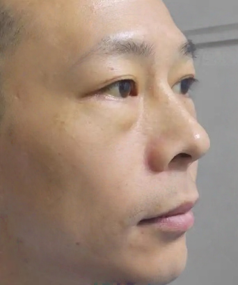 去眼袋手术