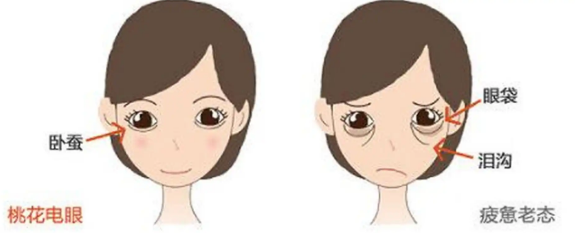 去眼袋手术