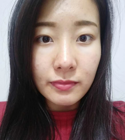 去眼袋手术