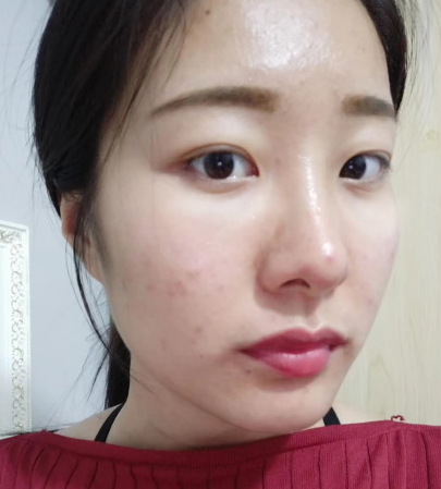 去眼袋手术