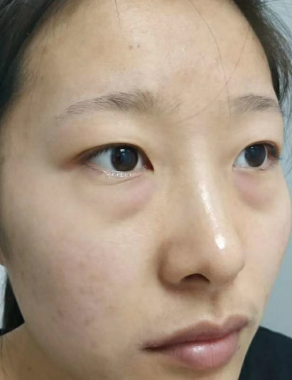 去眼袋手术