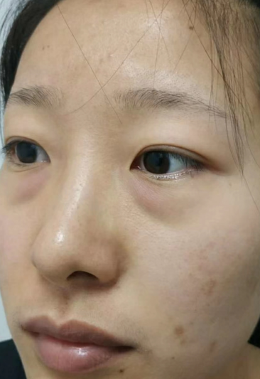 去眼袋手术