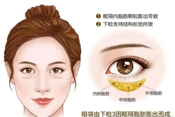 去眼袋手术