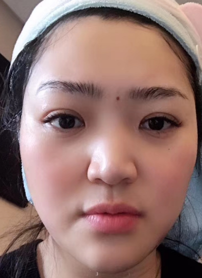去眼袋手术