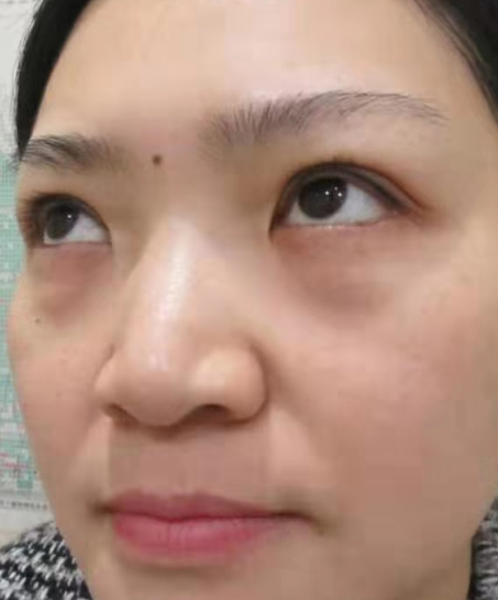 去眼袋手术