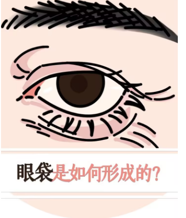 去眼袋手术