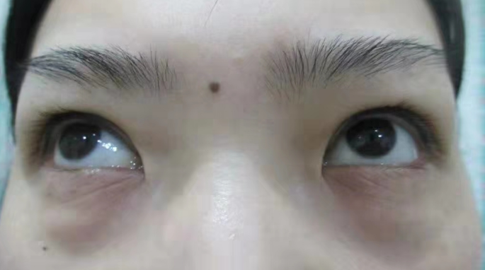 去眼袋手术