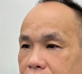 去眼袋手术