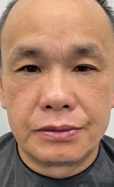 去眼袋手术