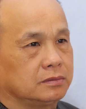 去眼袋手术