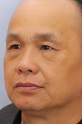 去眼袋手术