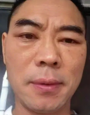 去眼袋手术