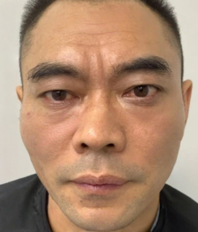 去眼袋手术