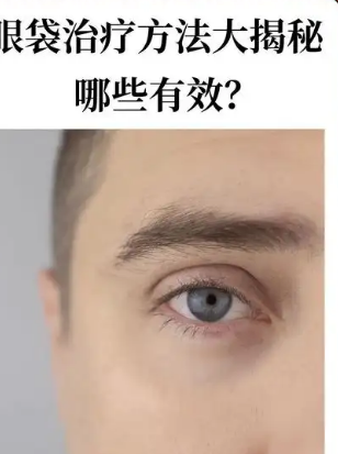 去眼袋手术