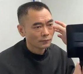 去眼袋手术