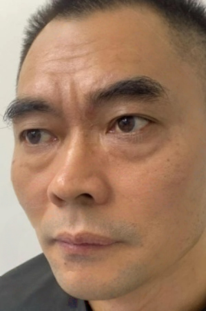 去眼袋手术