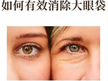 去眼袋手术