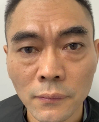去眼袋手术