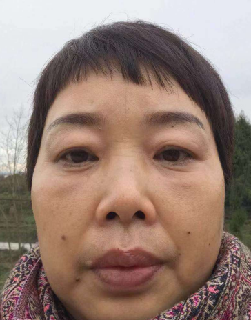 去眼袋手术