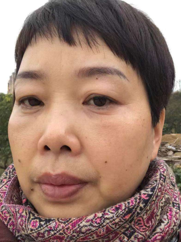 去眼袋手术
