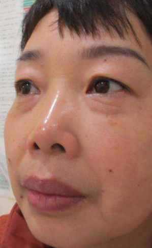 去眼袋手术